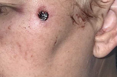 Katherine Wilson's facial wound from the stray bullet.